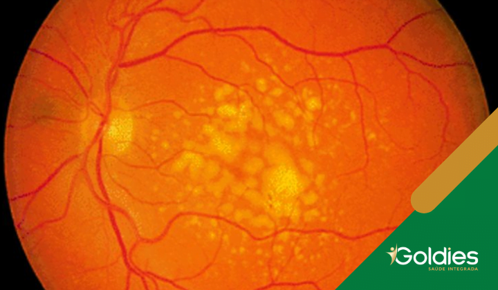 Imagem de close-up da retina de um olho mostrando padrões laranja e amarelo, com vasos sanguíneos visíveis, ilustrando o post "Degeneração Macular Relacionada À Idade (DMRI)"